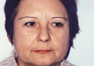 taktika-vedeniya-patsientov-s-pogranichnymi-involiutsionnymi-izmeneniyami-vza dermatokosmetologov-i-plasticheskikh-khirurgov