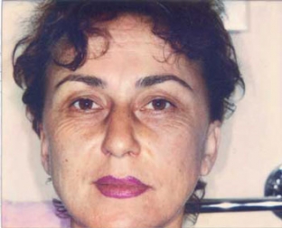 taktika-vedeniya-patsientov-s-pogranichnymi-involyutsionnymi-izmeneniyami-vzai dermatokosmetologov-i-plasticheskikh-khirurgov
