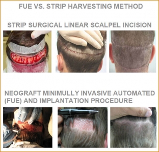 transplantatsiya-volos-metod-strip-vs- fue
