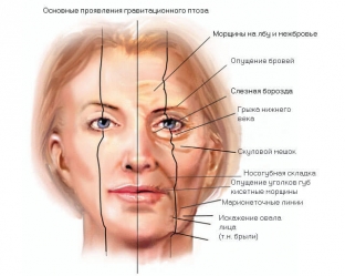 tri-stepeni-gravitatsionnogo-ptoza-litsa-kharakternye-priznaki