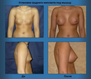 ustanovka-grudnogo-implanta-pod-myshtsu-o-chem-vazhno-znat-khirurgu