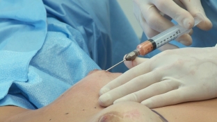 uvelichit-grud-bez-implantov-pomozhet-lipofiling-grudi