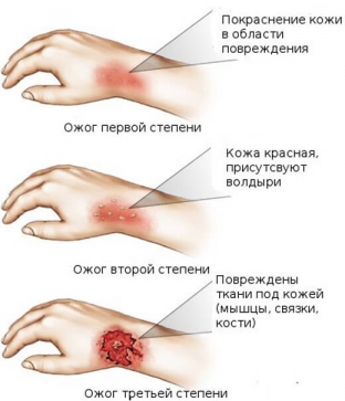uznajte-kak-okazat-pervuyu-pomoshch-pri-ozhoge