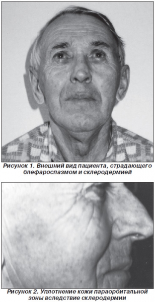vliyanie-sklerodermii-na-effekt-botulinoterapii-pri-blefarospazme