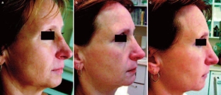 vosstanovlenie-kozhi-posle-invazivnykh-protsedur-vozmozhnosti-karboksiterapici