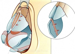 yuvelirnaya-khirurgiya-rinoplastika-konchika-nosa