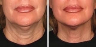 zhidkie-mezoniti-outline-gel-dlya-litsa-i-tela- osobennosti-primeneniya-i-effekt