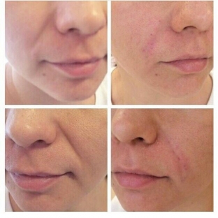 zhidkie-mezoniti-outline-gel-dlya-litsa-i-tela- osobennosti-primeneniya-i-effekt